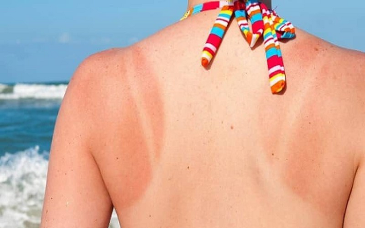 Bỏ t&uacute;i 8 c&aacute;ch trị ch&aacute;y nắng tại nh&agrave; đơn giản, dễ l&agrave;m m&agrave; cực hiệu quả